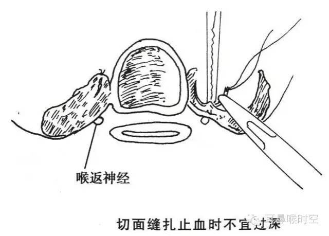 切除腺体的量:保留10克术式:甲状腺次全切除术麻醉:全麻气管插管手术