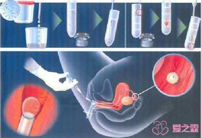 人工授精过程费用与试管婴儿的区别