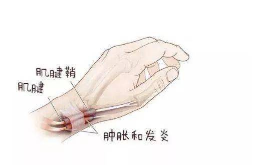 科普|大拇指腱鞘炎到底是什么?可以治疗吗?
