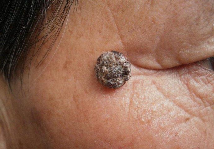 经常挤痘痘,易发老年疣