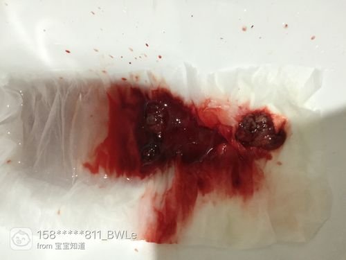 稽留流产,药流再清宫