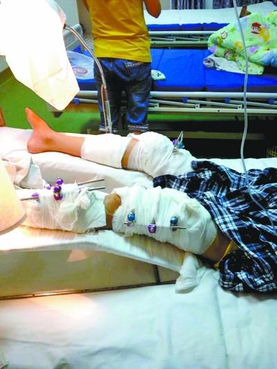 一家9口挤黑面的出车祸女儿骨折父亲懊悔不已