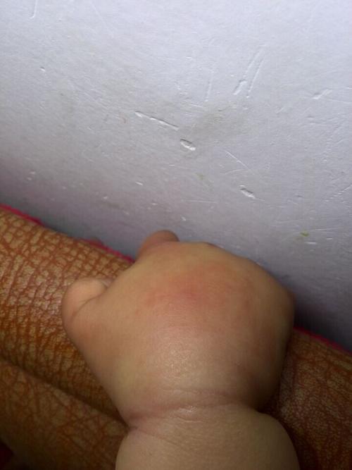 宝宝手昨天晚上被蚊子(可能是其他虫子)咬了,今天晚上