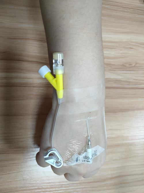 写美篇静脉留置针是临床输液治疗的常用工具,留置针的规范固定是静疗