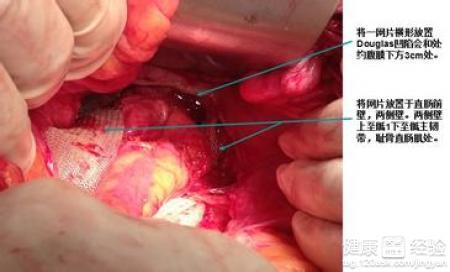 子宫脱垂的主要病因
