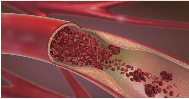 【健康科普漫谈】警惕体内的沉默杀手:下肢深静脉血栓