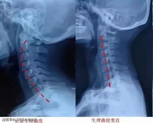 颈椎生理曲度变直还能恢复吗?该如何进行恢复?