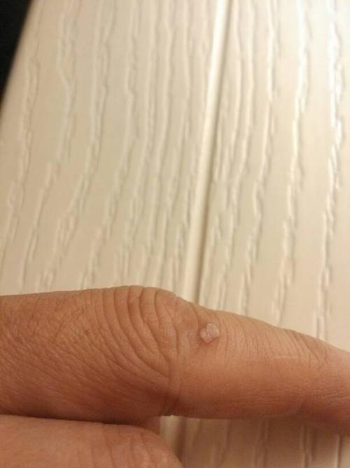 手指上长了一个肉包,不疼不痒,貌似在长大,求科普如何