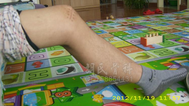 中医快速治愈膝关节弯曲受限