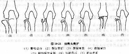 桡骨近端骨折分型   