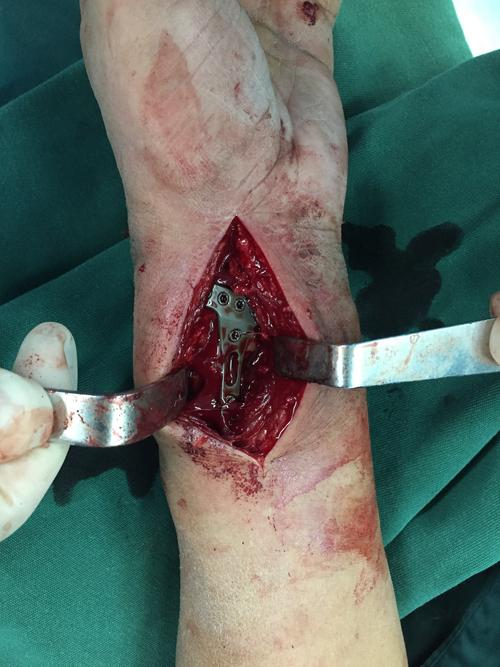 一例陈旧桡骨远端骨折手术完成