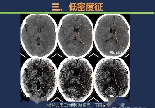 【影像】头颅ct如何预判超早期脑梗死?