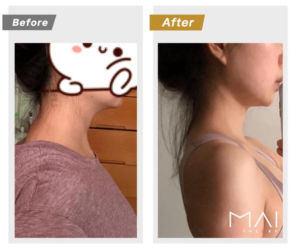 一露脖子就显老?别啥都怪低头