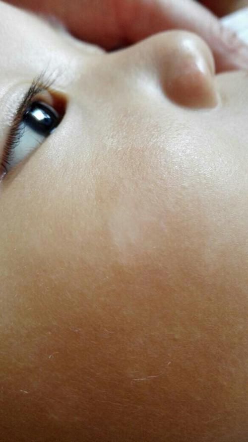 了婴宝后红点消失,成了一个白点,到医院检查大便,没有虫,医生说是汗斑