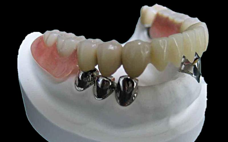 无挂钩精密假牙 不带挂钩 不拔牙 重新固定松动牙,不拔牙!