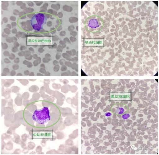 检验案例白细胞散点图灰区
