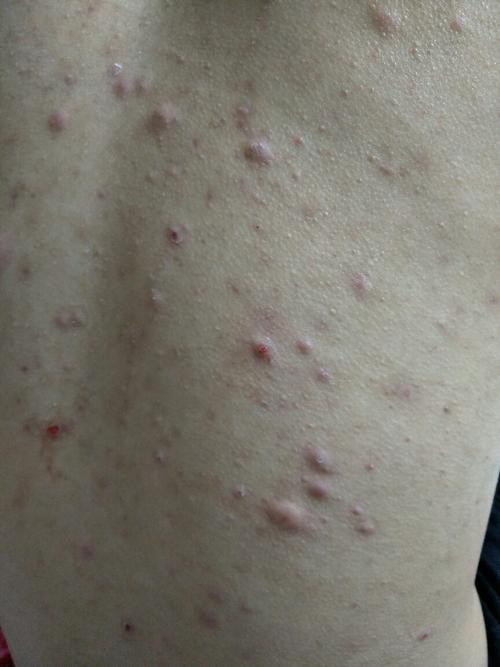 后背起这样的疙瘩,是怎么回事?什么情况造成的?