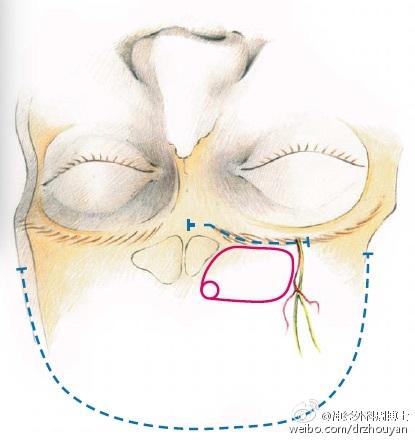 体位摆放完毕后,就需标记重要的解剖结构,如中线,眉间,额窦,眶上孔,眶