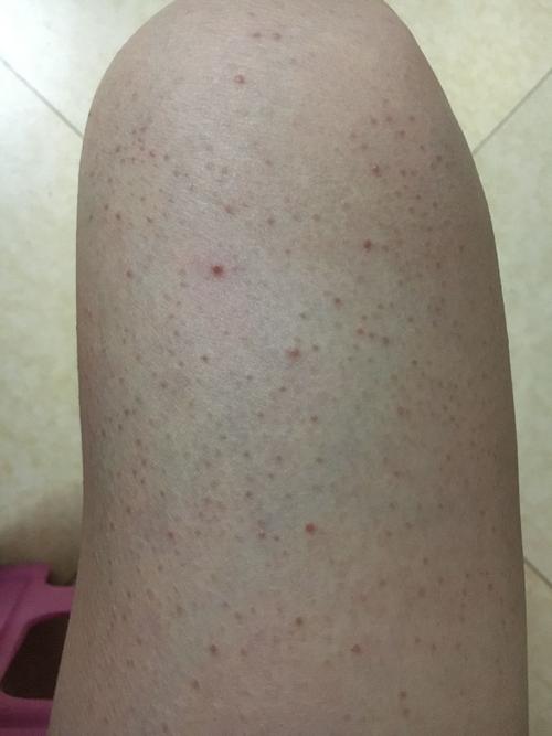 腿上这些是什么东西,自成年以后好像一直存在,有点像螨虫,里面有白