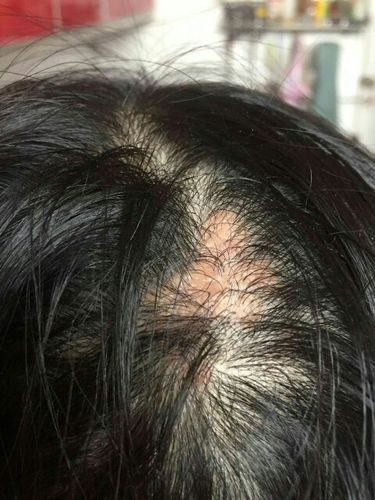 头顶一块头皮凸起,红色,几乎没有头发,不疼,有事偶尔会痒,好多年了,这