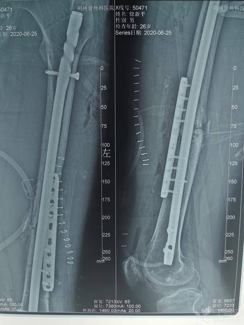 股骨干骨折不愈合次置骨换钉十钢板固定