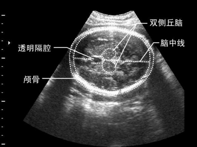 图3-2-20 胎头丘脑平面声像