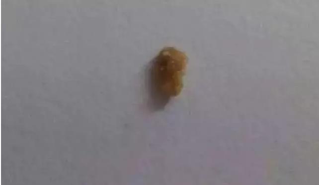 一个不到两岁半的幼儿,居然在体内发现了13mm的肾结石