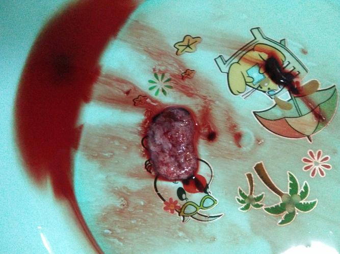 你好,我想问一下药物流产后做b