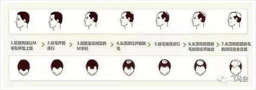 程序员确实更容易秃.