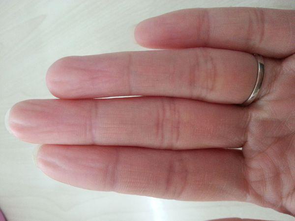 手指肚经常出现这样的情况,请问是怎么回事