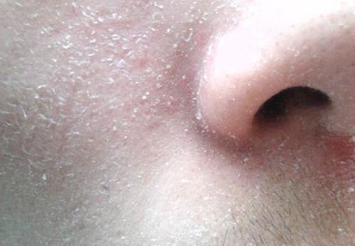 皮肤干燥起皮,立马补水?你没搞清楚这件事,你的皮肤会