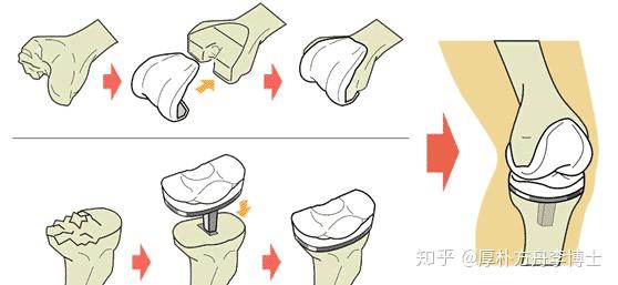 人工膝关节置换的类型包括 全膝关节置换术(tka)和 单髁关节置换术