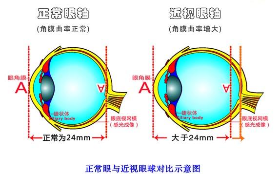 什么是近视眼