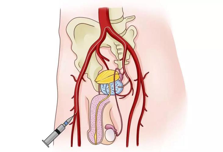 前列腺增生躲不过咋办?