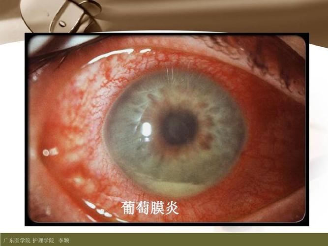 葡萄膜炎 广东医学院 护理学院 李颖