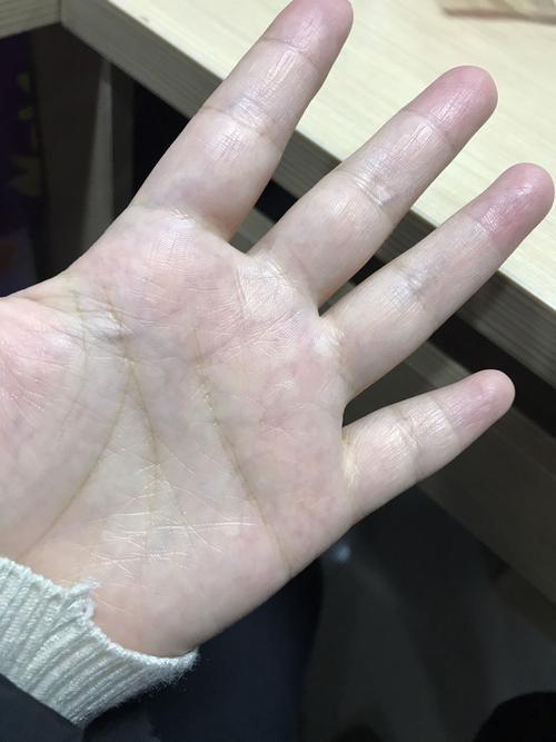 为什么我手掌心的血管那么明显可以看到 特别是左手无名指上的血管都