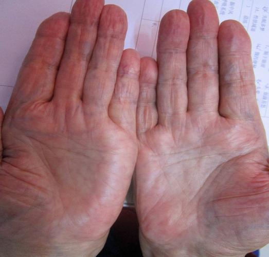 所以此色手掌多数为 心脑血管疾病 糖尿病病情加重的人群.