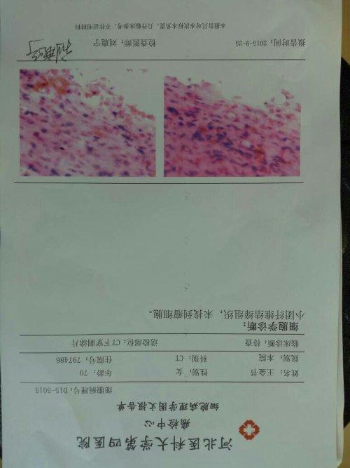 怀疑是淋巴癌,做了ct下穿刺,检验结果出来了.