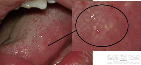 为艾滋病后,也会引起口腔疾病,比如牙周炎,表现为牙根发炎,出现溃疡