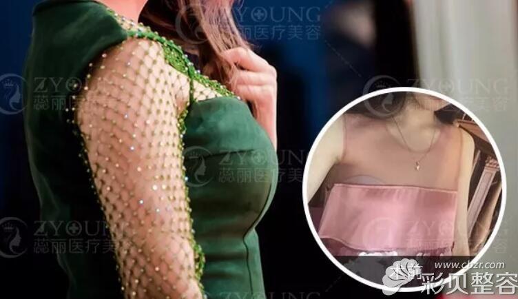 自体脂肪丰胸有什么副作用?北京知音赵禹翔揭秘隆胸二