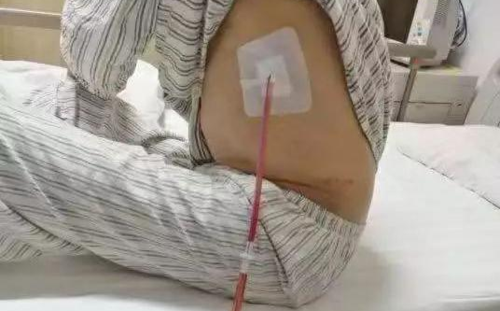 (4)保护引流管周围的皮肤:伤口周围的敷料要保持清洁干燥,每天定时