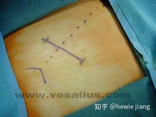 mcburney与阑尾炎