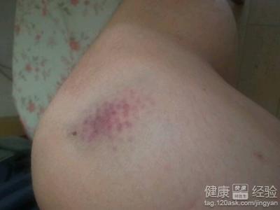 白血病会淤青吗