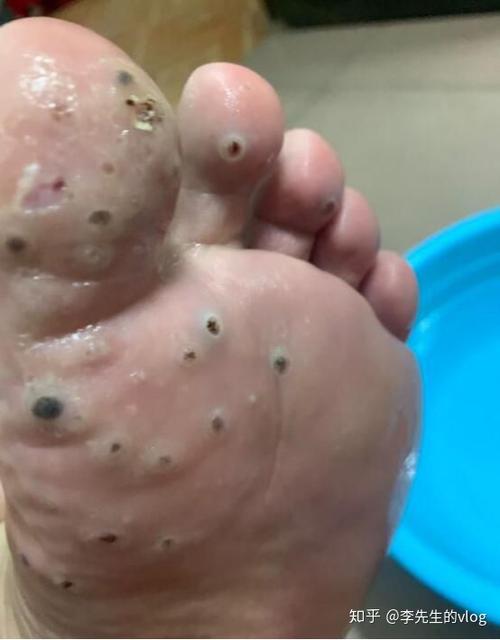 请问一下,你们得跖疣是怎么解决的?