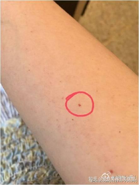 今天讲一讲最常见的一种血管瘤——樱桃样血管瘤.