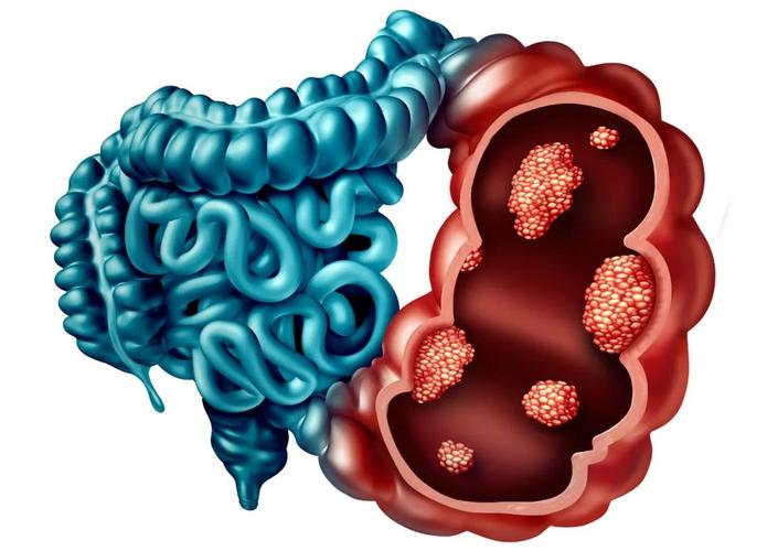 挽救乙状结肠腺癌晚期高龄患者生命!中置盛京成功完成
