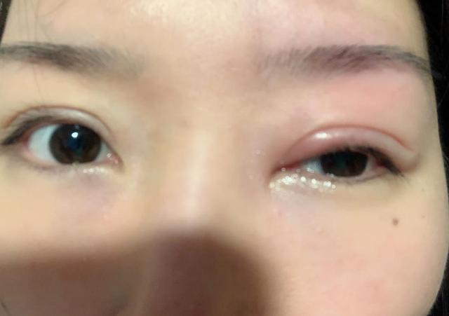 表现为眼睛脓肿突然下陷,黑色无脓,肿胀迅速蔓延,伴有高烧头痛,易怒