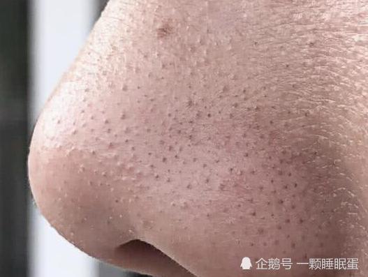 女生鼻子上全是黑乎乎"黑头"?千万别手挤,日常简单3招即可