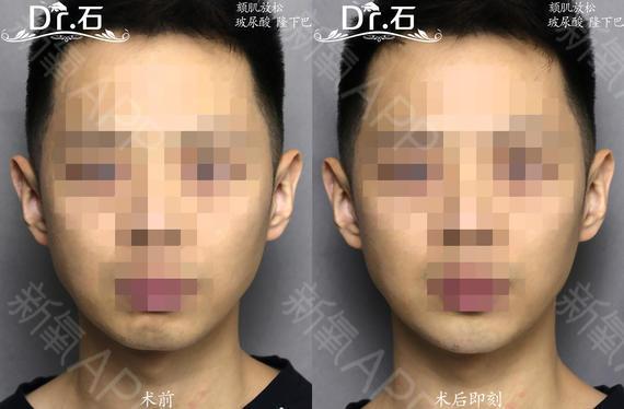 case no638 玻尿酸注射下巴颏肌放松联合治疗,下巴更加圆润,玻尿酸更