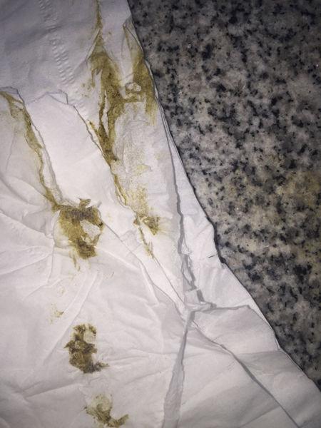 肝病患者.这个颜色算黑便么.